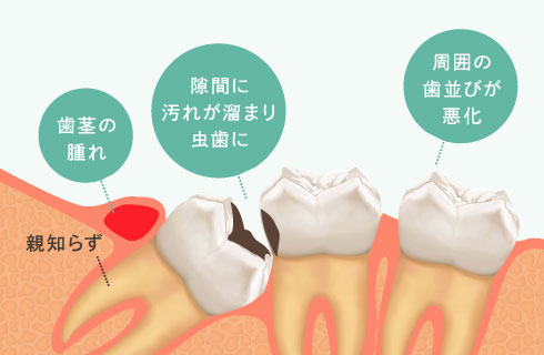 歯茎の腫れ、隙間に汚れが溜まりむし歯に、周囲の歯並びが悪化